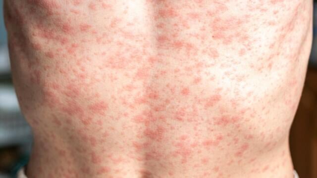 cbsn-fusion-child-dies-after-contracting-measles-in-texas-officials-say-thumbnail.jpg 