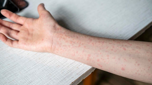 A teenager's hands covered in a measles rash. 